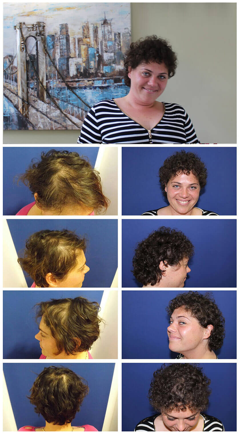 Hair Restoration for Woman