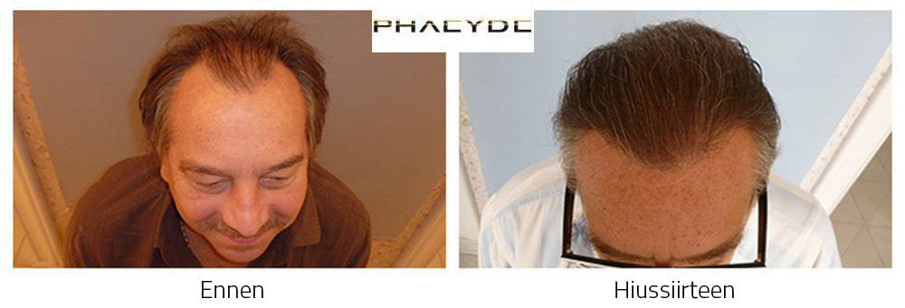 Hiustensiirto ennen ja jälkeen - Imre Bajor - 4000+ graft