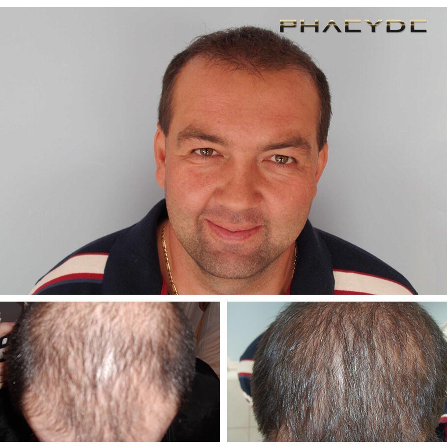 Transplantacija kose fue fue rezultati pre posle fotografija laszlo d - PHAEYDE Клиника