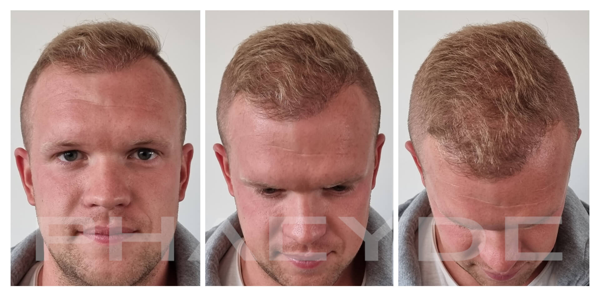 Patrik 7 Months After Hair Transplantation Patrik 7 Months After Hair Transplantation