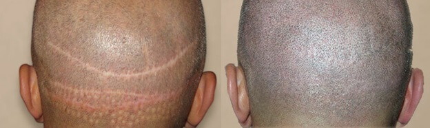 SMP (mikro pigmentácia pokožky hlavy) pred a po