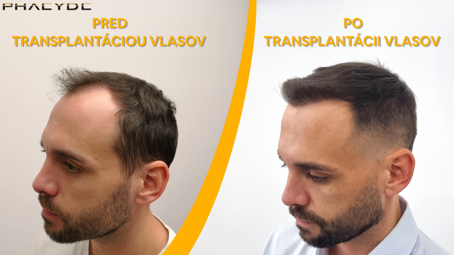 Blažej pred a po transplantácii vlasov Blažej pred a po transplantácii vlasov