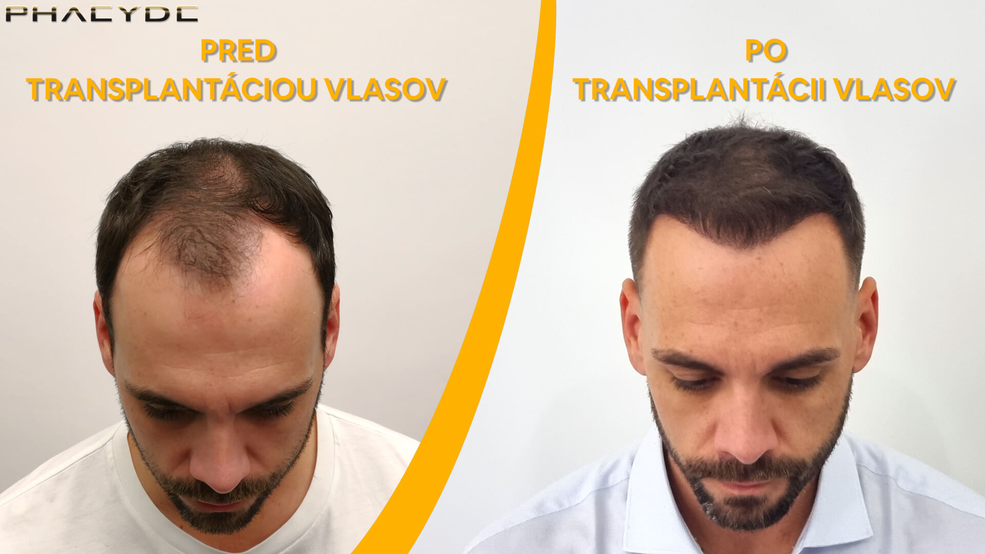 Blažej pred a po transplantácii vlasov Blažej pred a po transplantácii vlasov