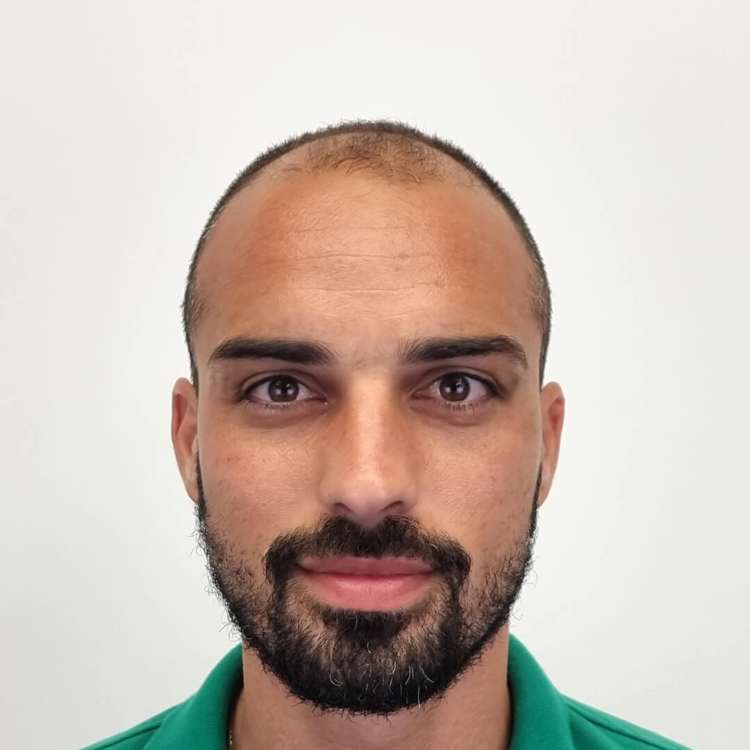 Transplantácia vlasov pred-po: Lucas - PHAEYDE Clinic
