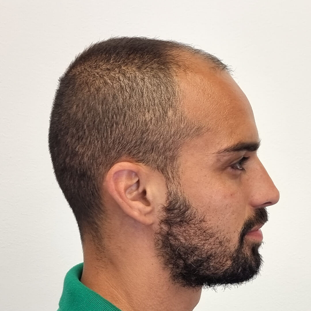 Transplantácia vlasov pred-po: Lucas - PHAEYDE Clinic