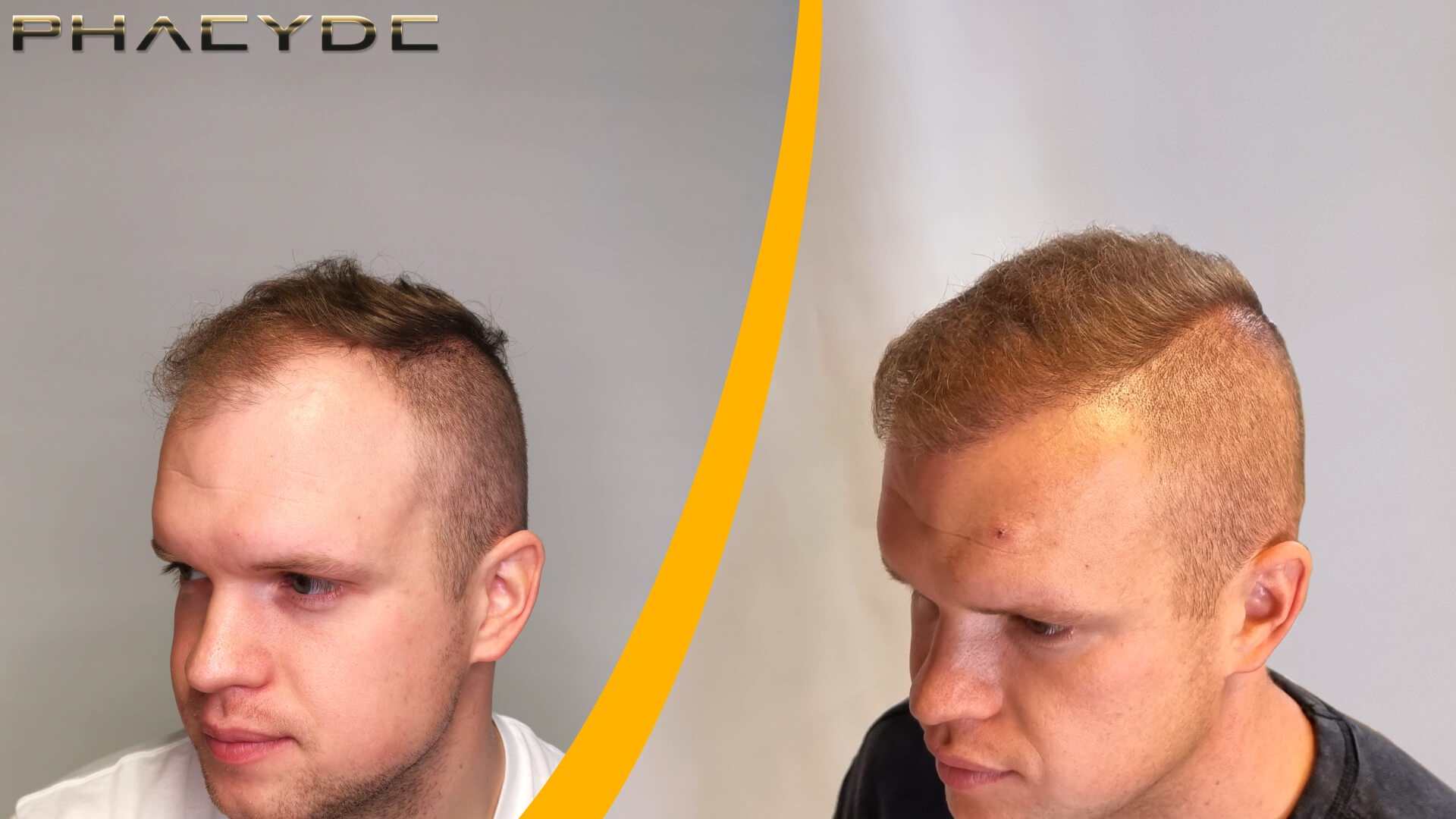 Patrik: Pred a Po Transplantácii Vlasov Patrik: Pred a Po Transplantácii Vlasov
