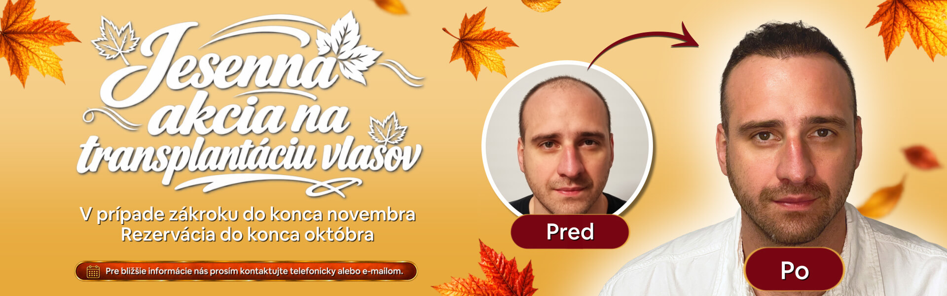 Jesenná akcia na transplantáciu vlasov - PHAEYDE Clinic Bratislava