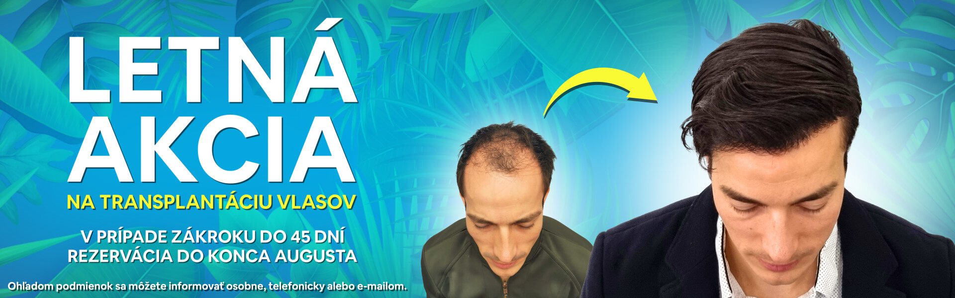 Jesenná akcia na transplantáciu vlasov - PHAEYDE Clinic Bratislava