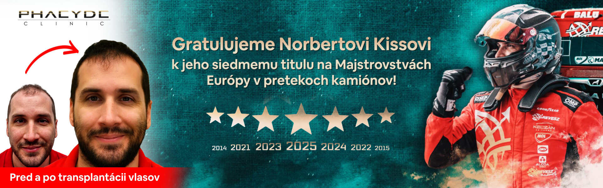 Norbert Kiss Transplantácia Vlasov Pred Po - PHAEYDE Clinic Bratislava