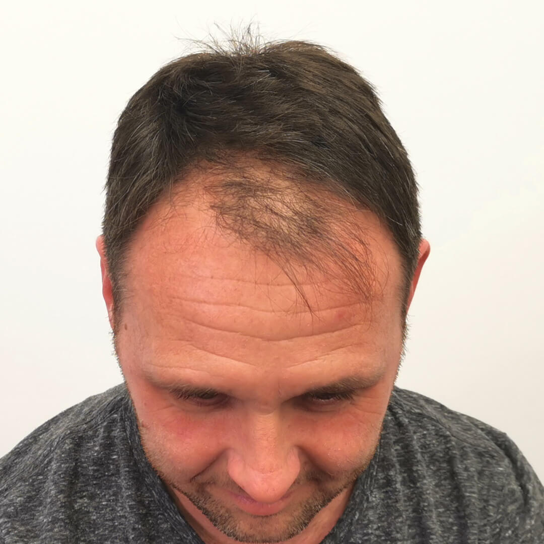 Transplantácia vlasov pred-po: Jozef - PHAEYDE Clinic