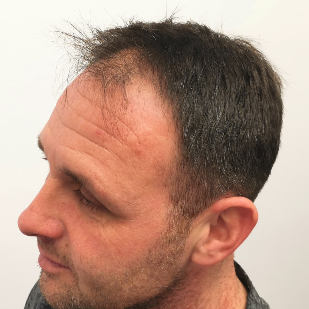 Transplantácia vlasov pred-po: Jozef - PHAEYDE Clinic