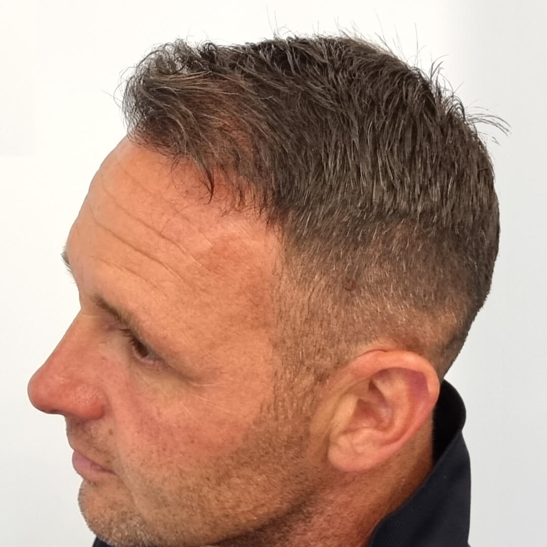 Transplantácia vlasov pred-po: Jozef - PHAEYDE Clinic