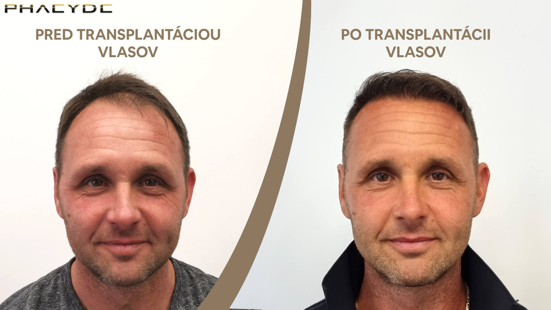 Transplantácia vlasov pred-po: Jozef - PHAEYDE Clinic
