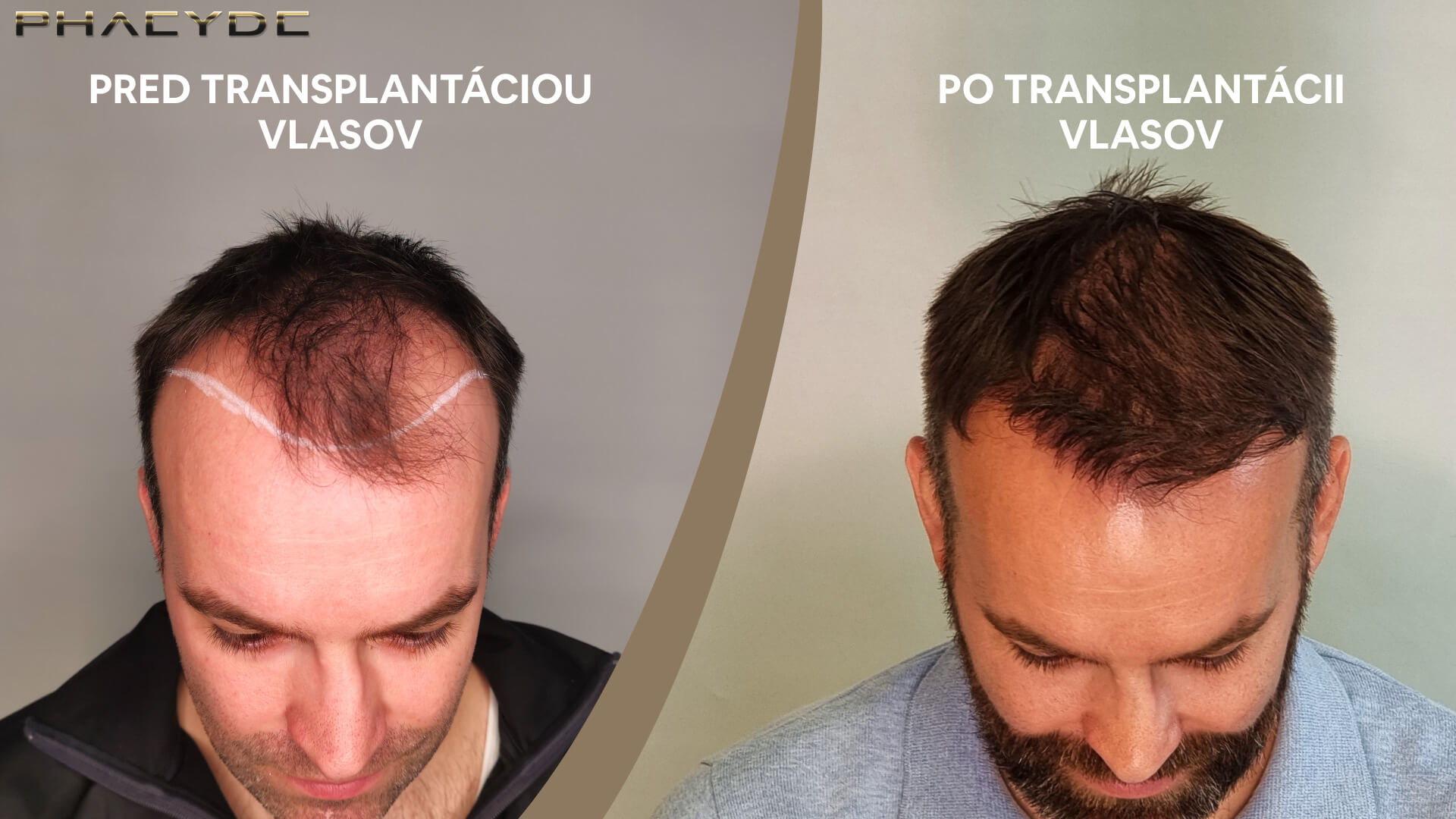 Transplantácia vlasov pred a po – Martin, PHAEYDE Clinic