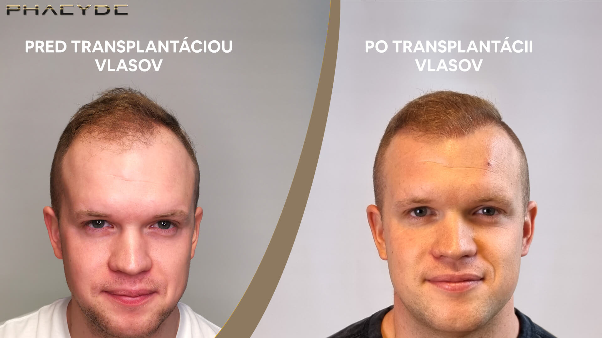 Patrikov stav pred a po transplantácii vlasov, vývoj vlasovej línie a hustoty vlasov po zákroku vykonanom na klinike PHAEYDE.