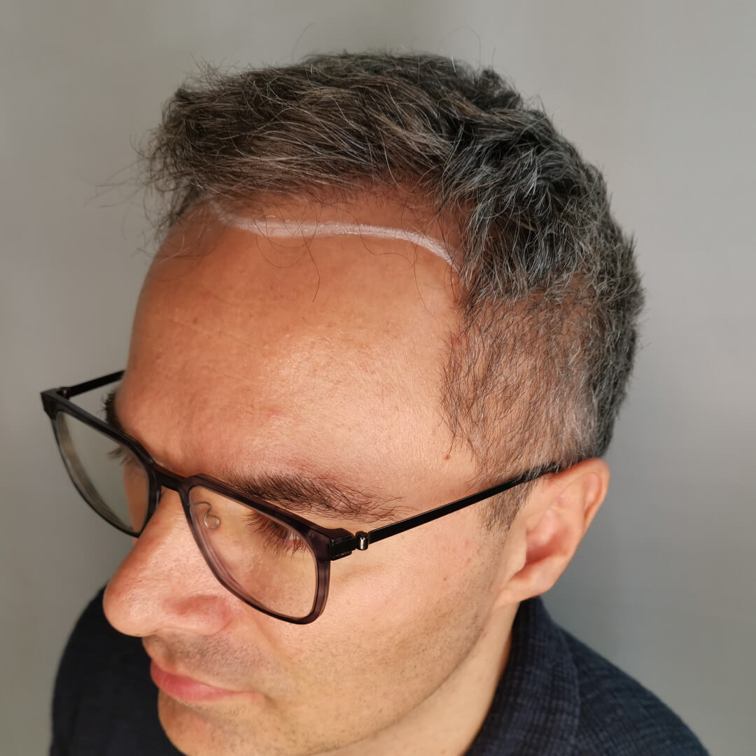 Transplantácia vlasov pred-po: Pavel - PHAEYDE Clinic