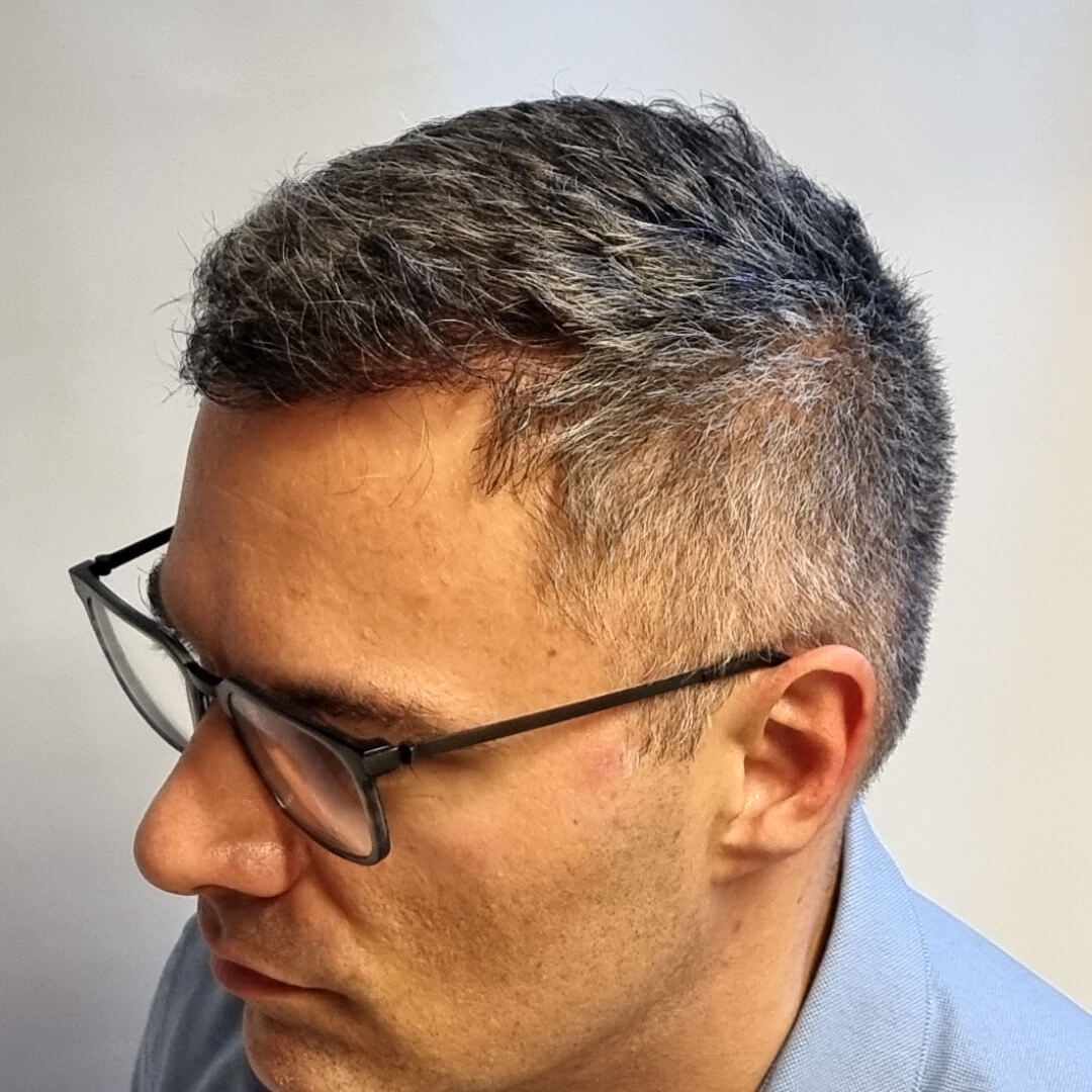 Transplantácia vlasov pred-po: Pavel - PHAEYDE Clinic