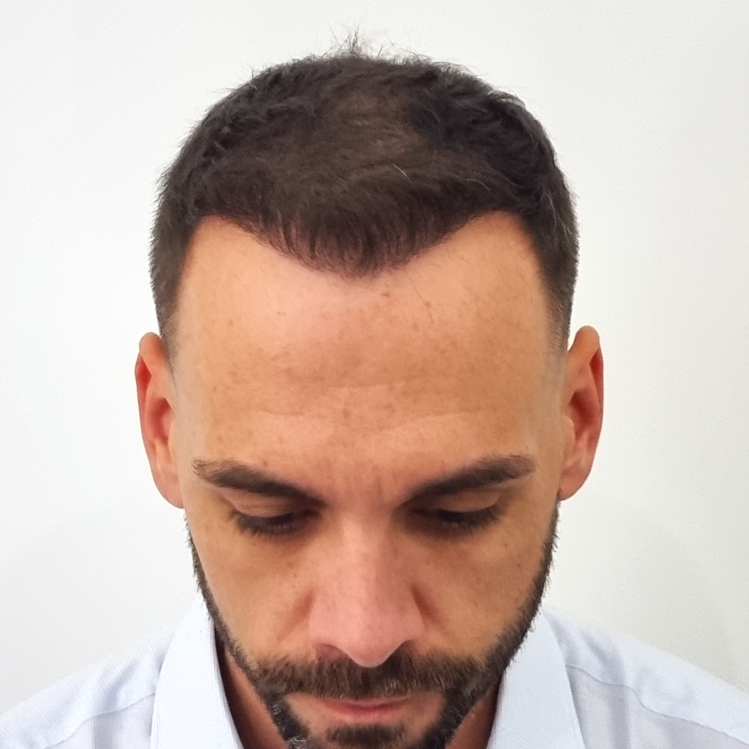 Transplantácia vlasov pred-po: Peter - PHAEYDE Clinic Bratislava