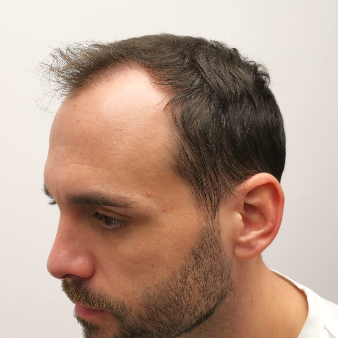 Transplantácia vlasov pred-po: Peter - PHAEYDE Clinic Bratislava