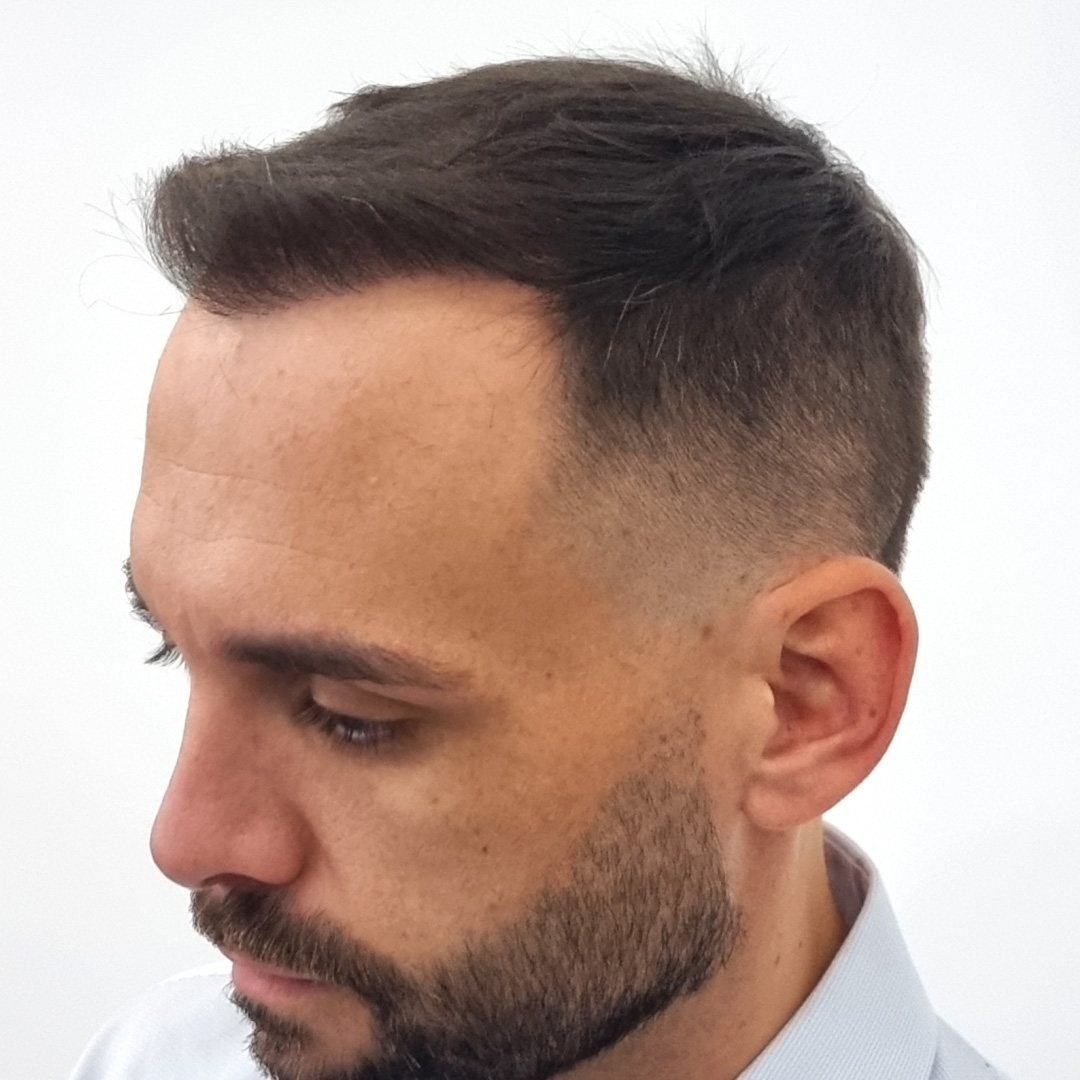 Transplantácia vlasov pred-po: Peter - PHAEYDE Clinic Bratislava