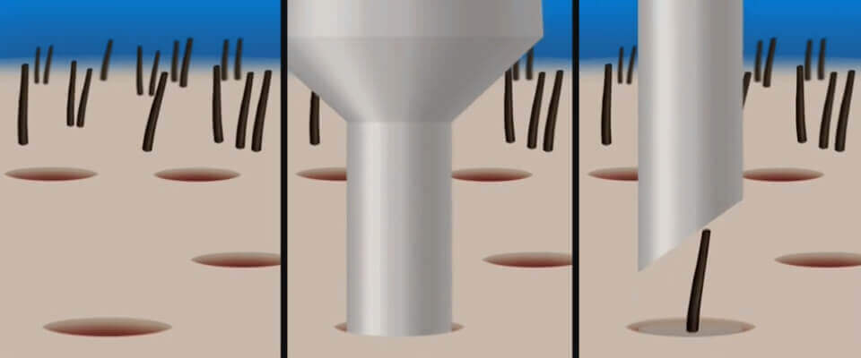 Transplantácia vlasov - Metóda FUE - PHAEYDE Clinic