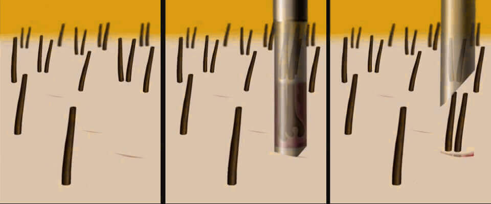 Transplantácia vlasov - Metóda S.H.E. - PHAEYDE Clinic