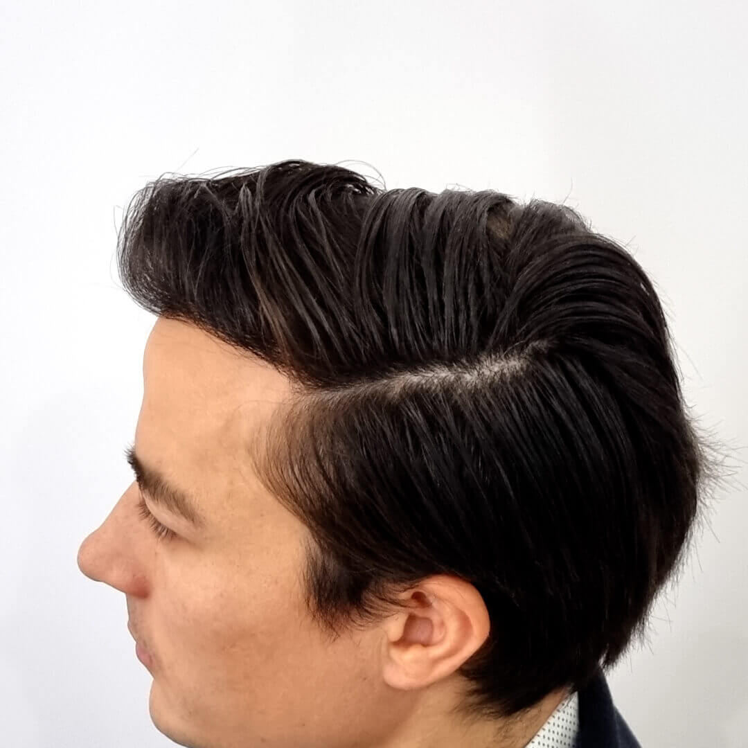 Transplantácia vlasov pred-po: Gregor - PHAEYDE Clinic Bratislava