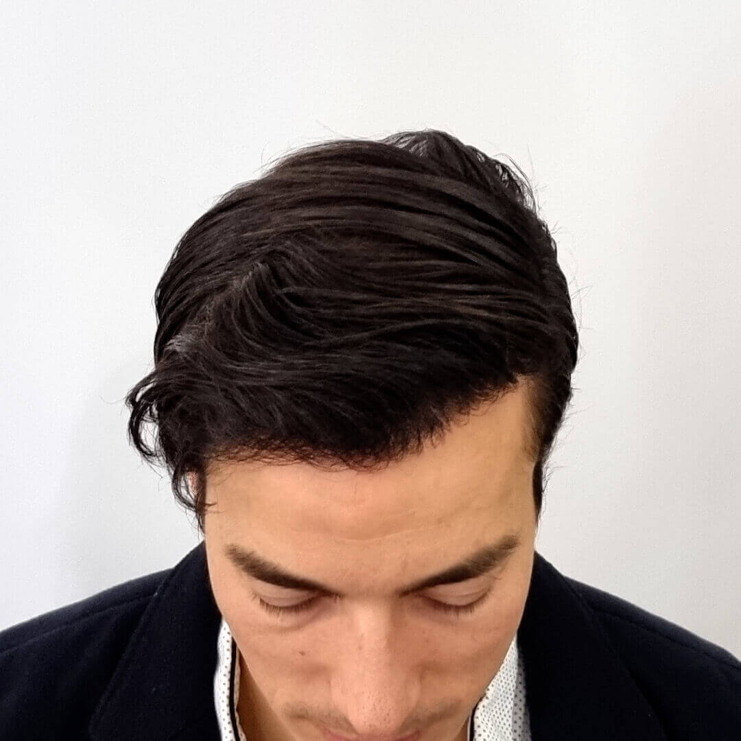 Transplantácia vlasov pred-po: Gregor - PHAEYDE Clinic Bratislava